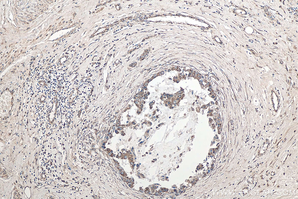 IHC staining of human breast cancer using 14299-1-AP