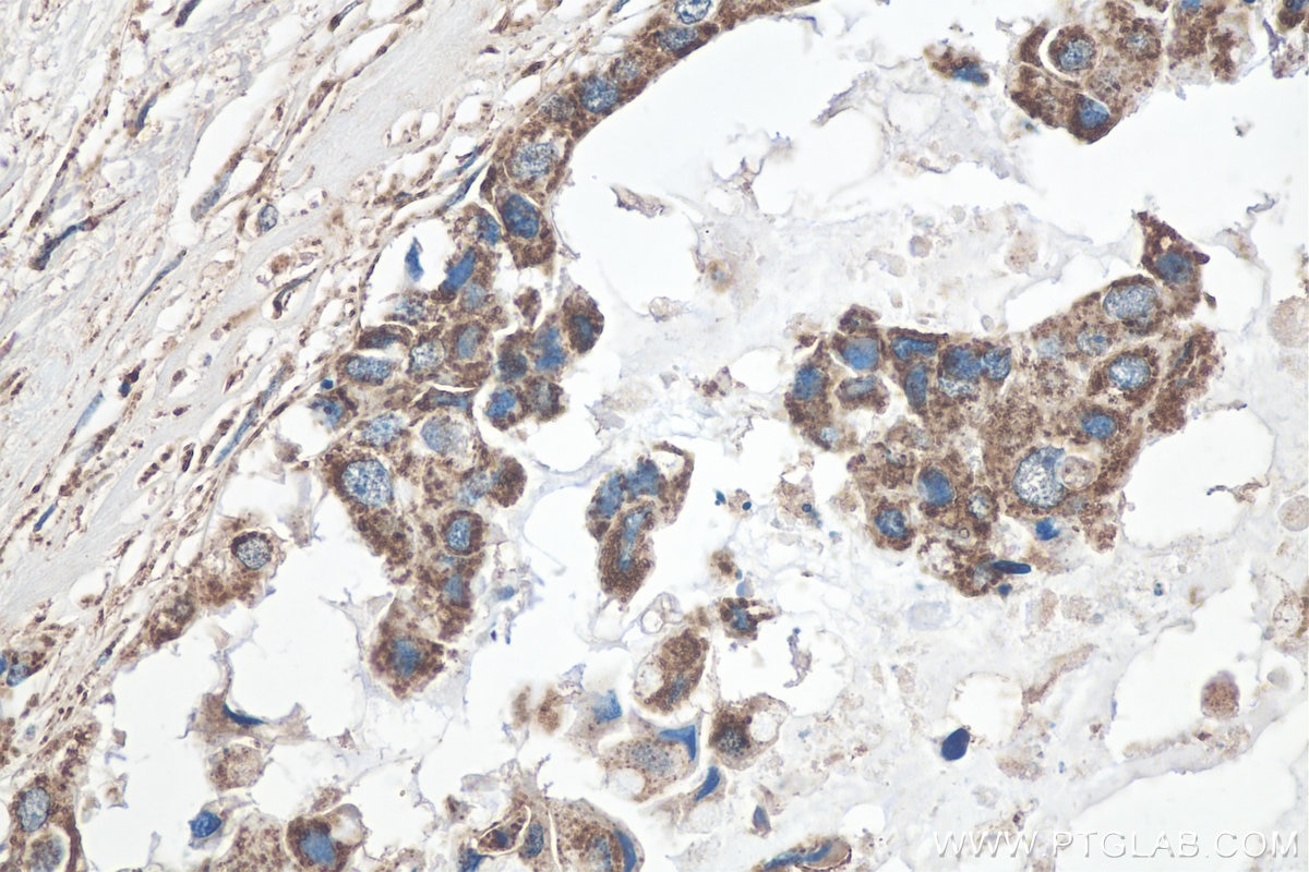 Immunohistochemistry (IHC) staining of human breast cancer tissue using GLUD1 Polyclonal antibody (14299-1-AP)