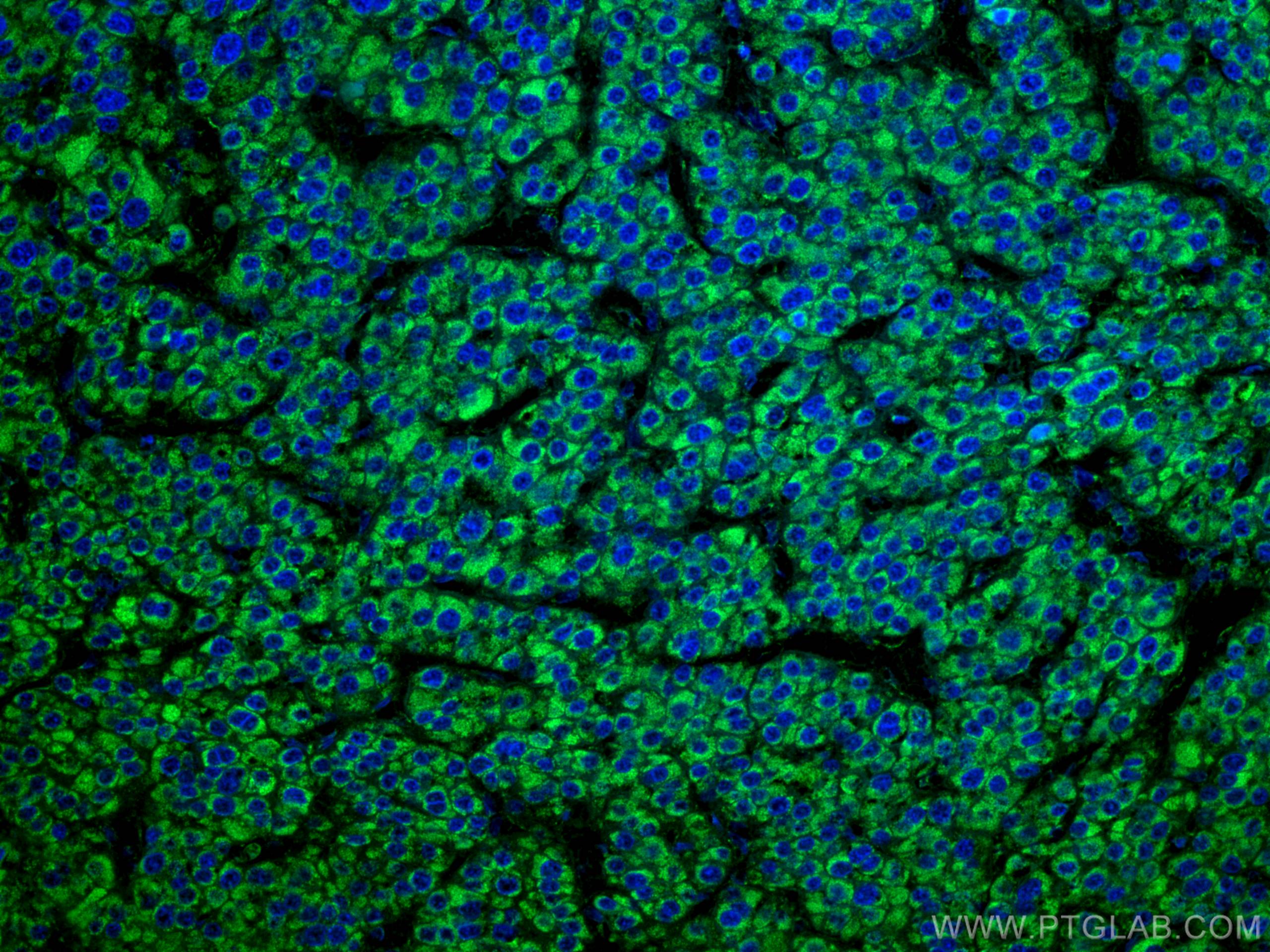 Immunofluorescence (IF) / fluorescent staining of human liver cancer tissue using GLUD1 Monoclonal antibody (67026-1-Ig)