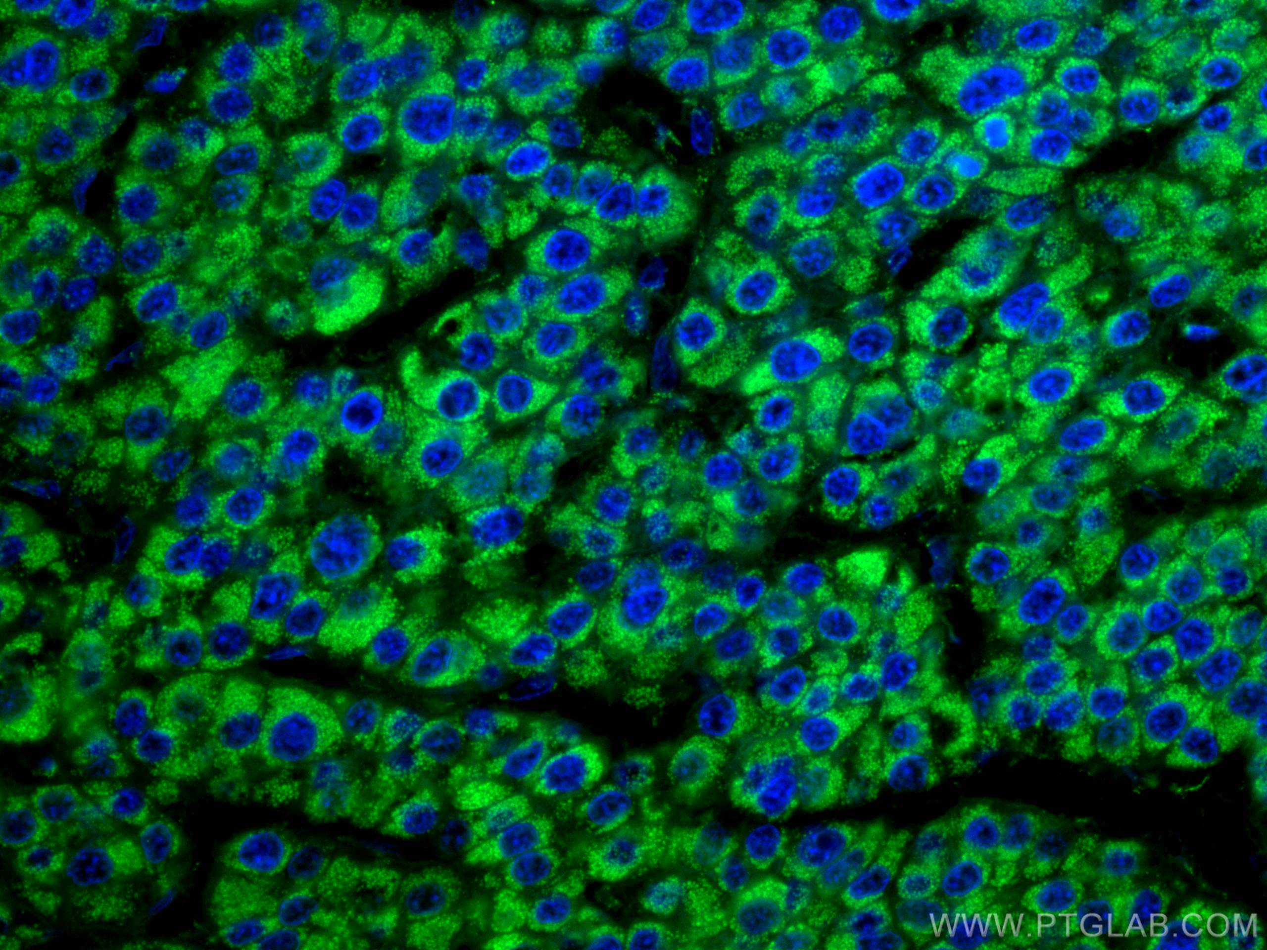 Immunofluorescence (IF) / fluorescent staining of human liver cancer tissue using GLUD1 Monoclonal antibody (67026-1-Ig)