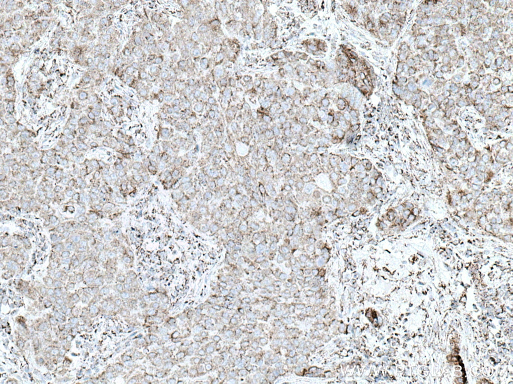 Immunohistochemistry (IHC) staining of human breast cancer tissue using GLUD1 Monoclonal antibody (67026-1-Ig)