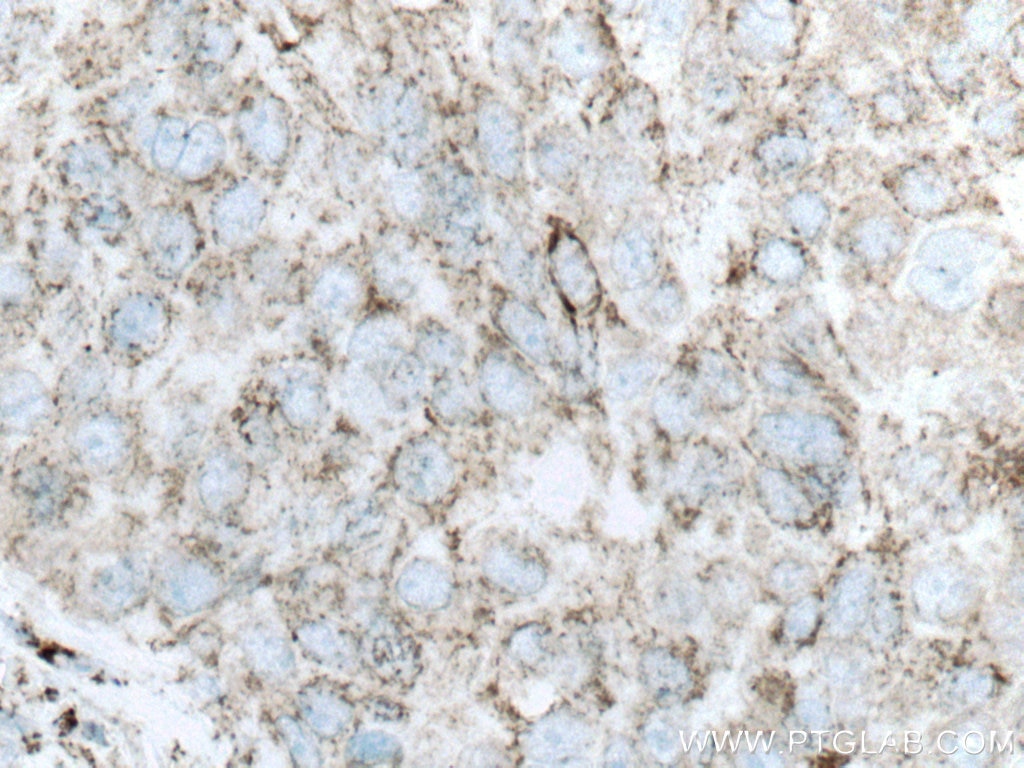 IHC staining of human breast cancer using 67026-1-Ig