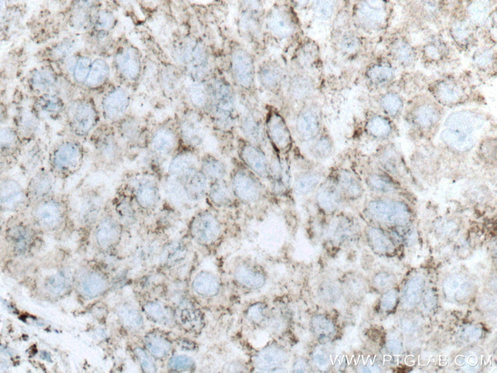 Immunohistochemistry (IHC) staining of human breast cancer tissue using GLUD1 Monoclonal antibody (67026-1-Ig)