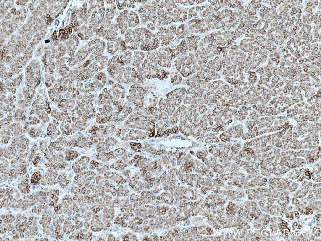 Immunohistochemistry (IHC) staining of human liver cancer tissue using GLUD1 Monoclonal antibody (67026-1-Ig)