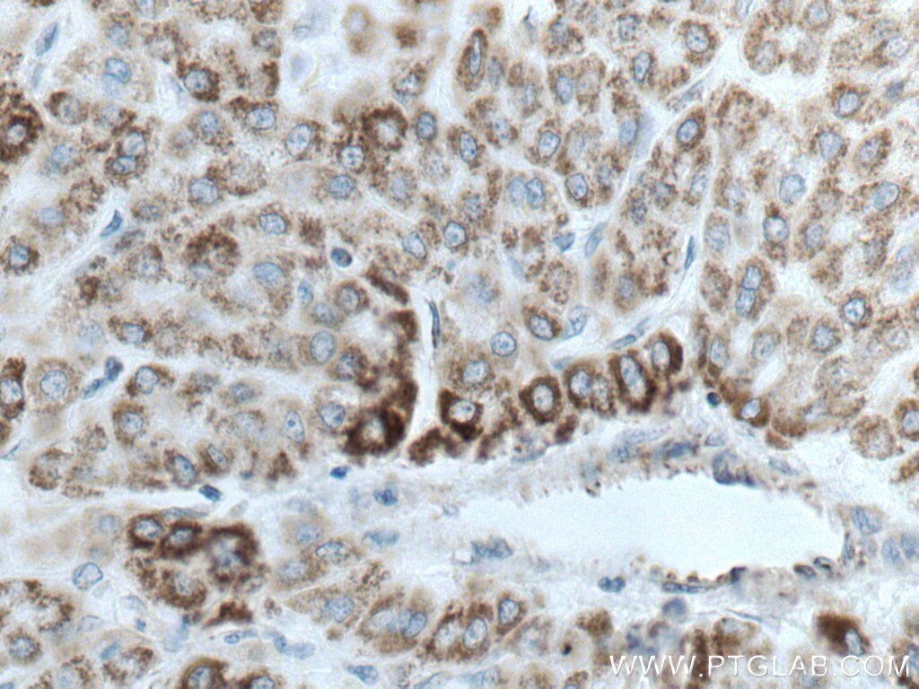 Immunohistochemistry (IHC) staining of human liver cancer tissue using GLUD1 Monoclonal antibody (67026-1-Ig)