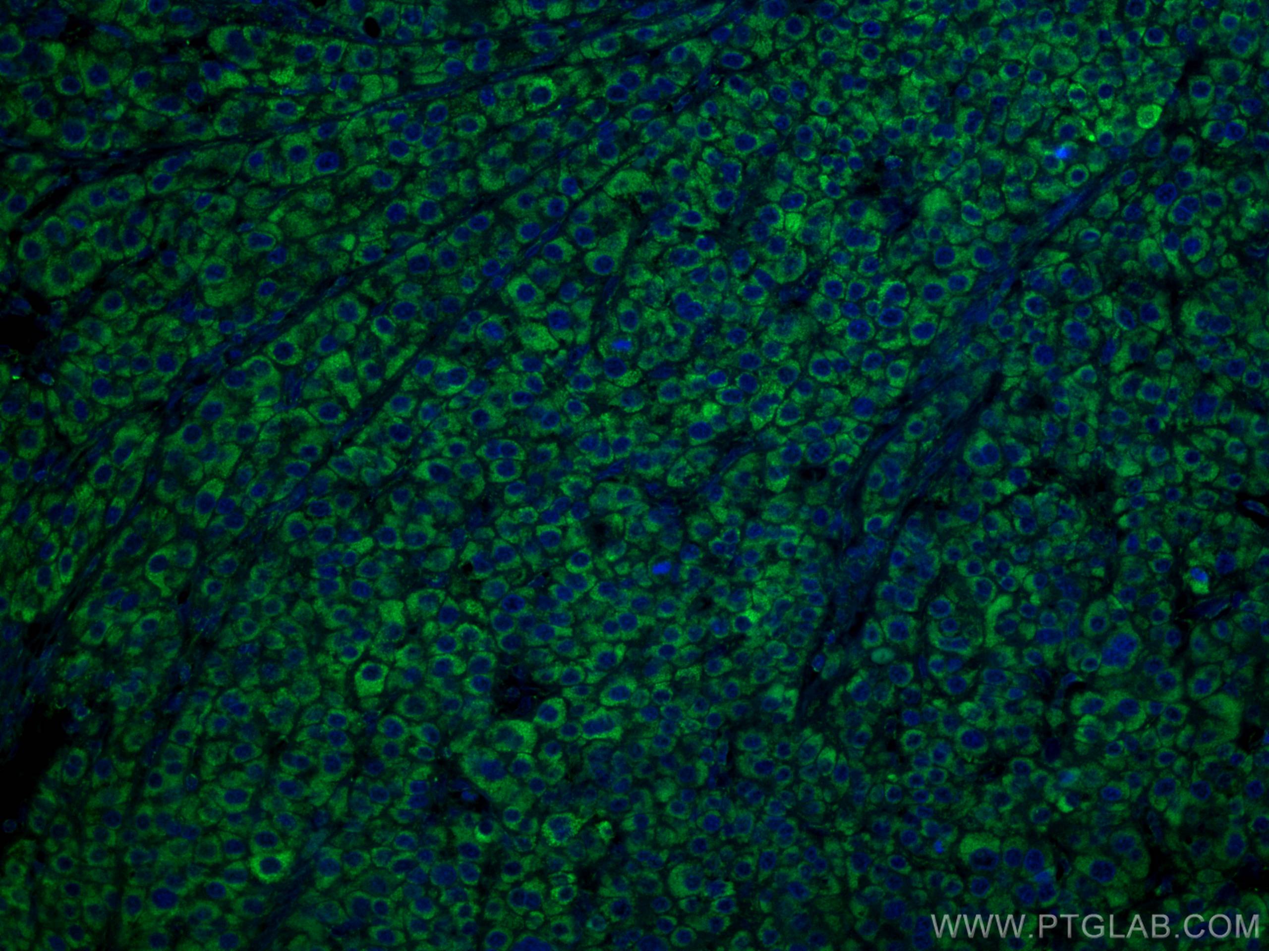 Immunofluorescence (IF) / fluorescent staining of human liver cancer tissue using CoraLite® Plus 488-conjugated GLUD1 Monoclonal ant (CL488-67026)