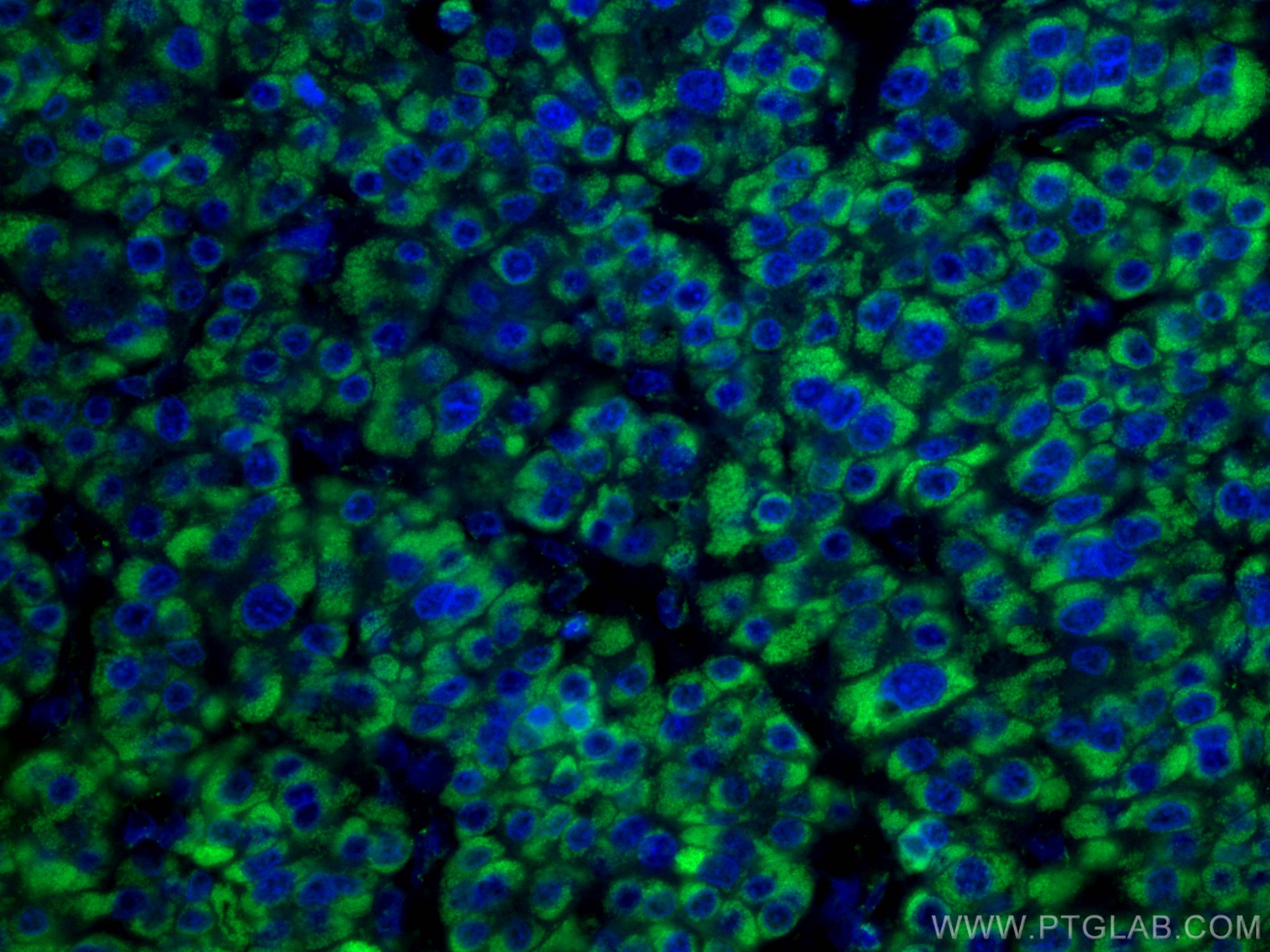 Immunofluorescence (IF) / fluorescent staining of human liver cancer tissue using CoraLite® Plus 488-conjugated GLUD1 Monoclonal ant (CL488-67026)