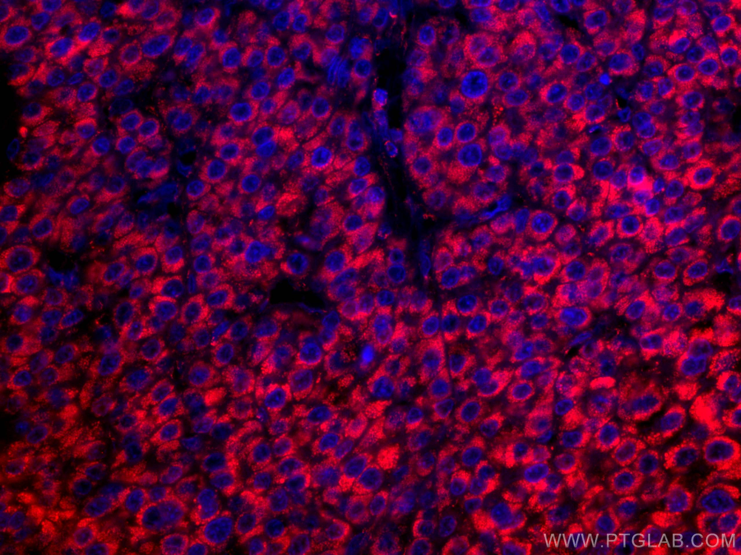 IF Staining of human liver cancer using CL594-67026