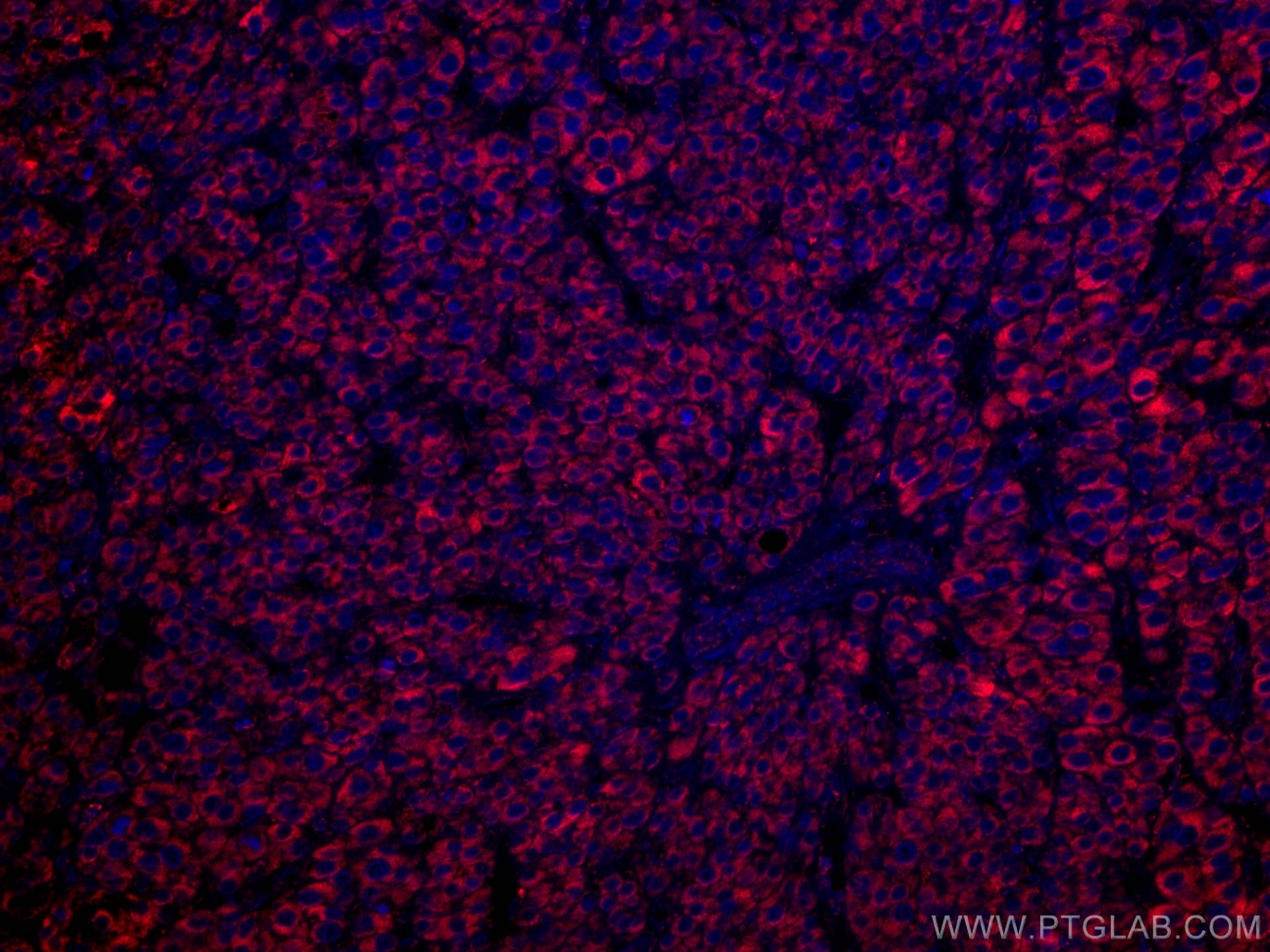Immunofluorescence (IF) / fluorescent staining of human liver cancer tissue using CoraLite®594-conjugated GLUD1 Monoclonal antibody (CL594-67026)