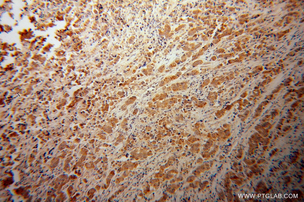 Immunohistochemistry (IHC) staining of human prostate cancer tissue using GLUD2 Polyclonal antibody (14462-1-AP)