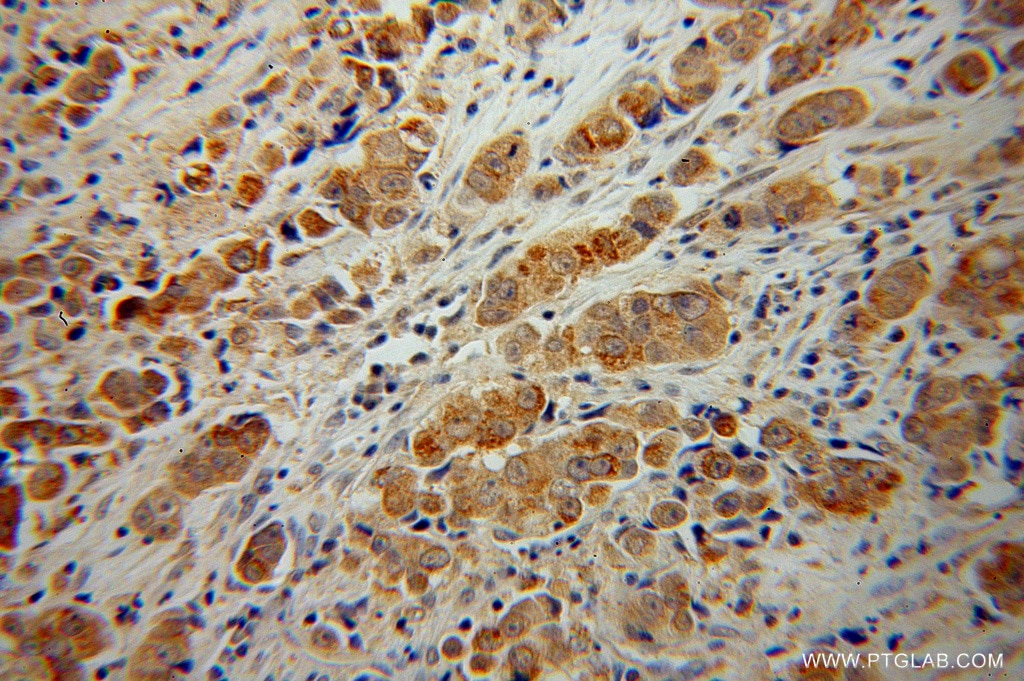 Immunohistochemistry (IHC) staining of human prostate cancer tissue using GLUD2 Polyclonal antibody (14462-1-AP)