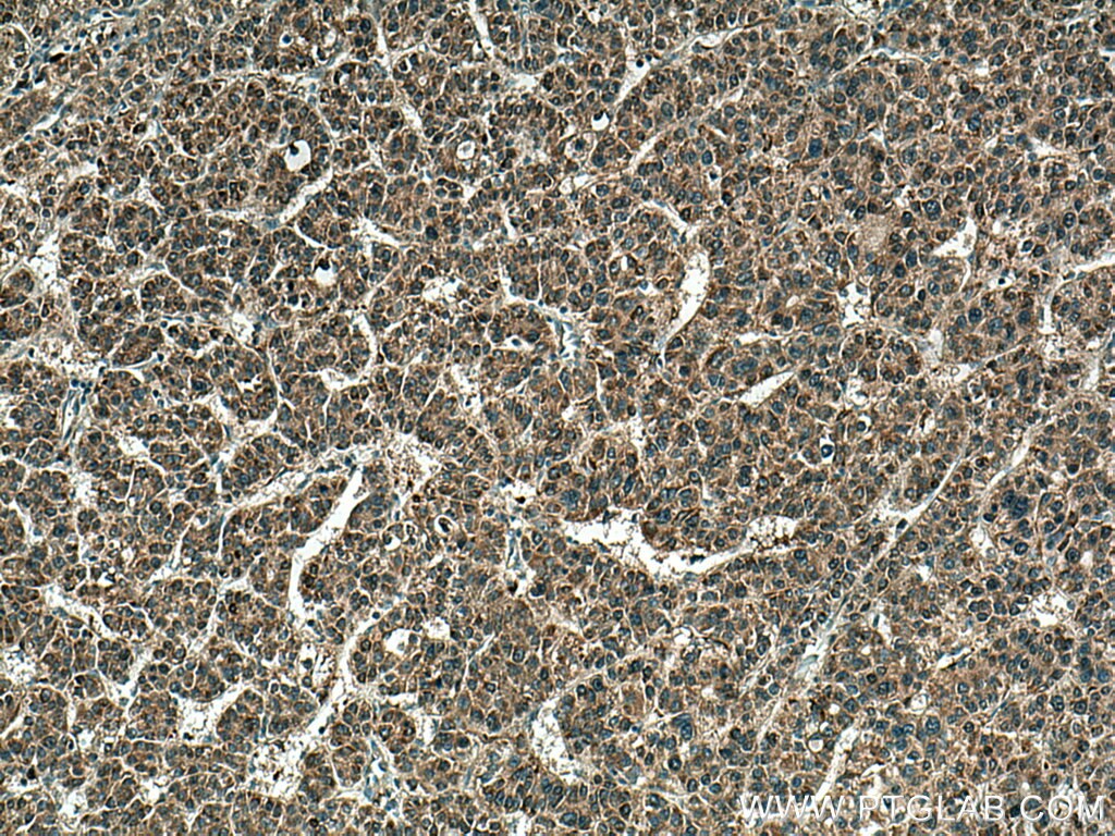 IHC staining of human liver cancer using 11037-2-AP