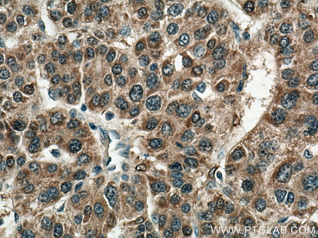 IHC staining of human liver cancer using 11037-2-AP