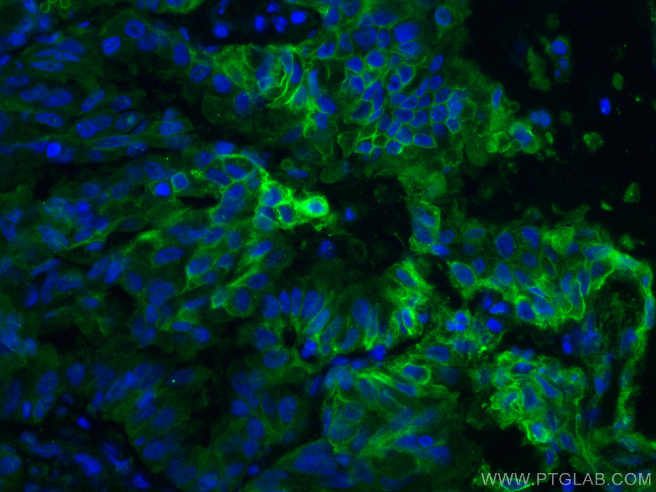 Immunofluorescence (IF) / fluorescent staining of human lung cancer tissue using GLUT1 Monoclonal antibody (66290-1-Ig)