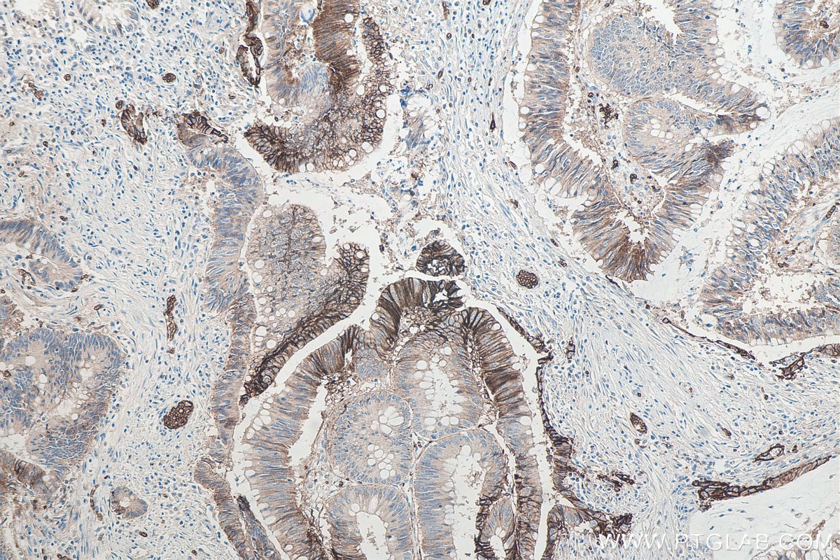 Immunohistochemistry (IHC) staining of human colon cancer tissue using GLUT1 Monoclonal antibody (66290-1-Ig)