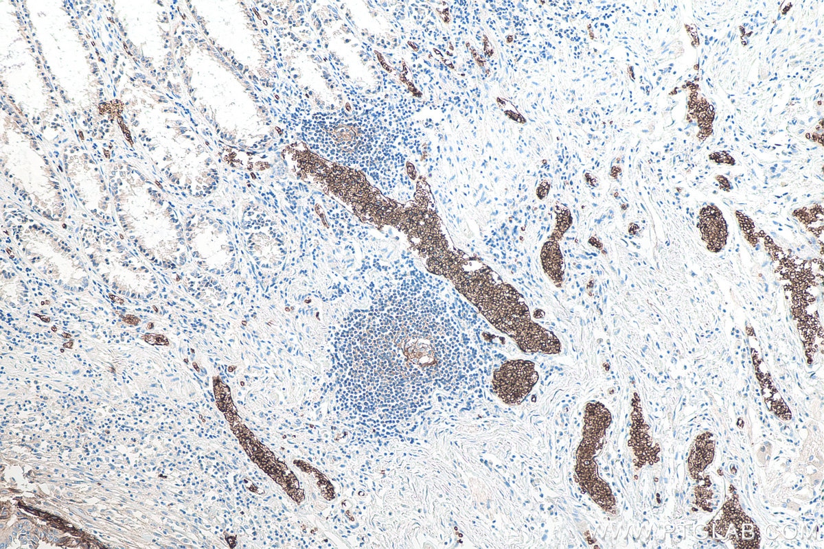 Immunohistochemistry (IHC) staining of human colon cancer tissue using GLUT1 Monoclonal antibody (66290-1-Ig)