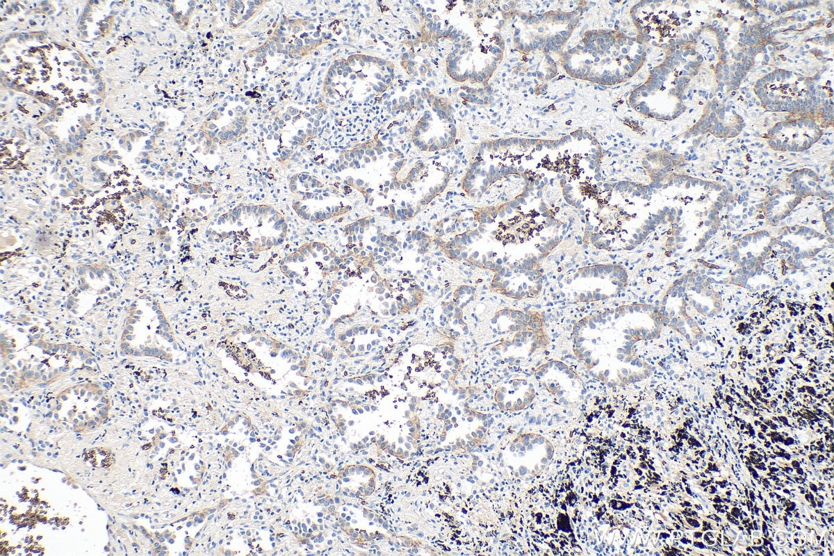 Immunohistochemistry (IHC) staining of human lung cancer tissue using GLUT1 Monoclonal antibody (66290-1-Ig)