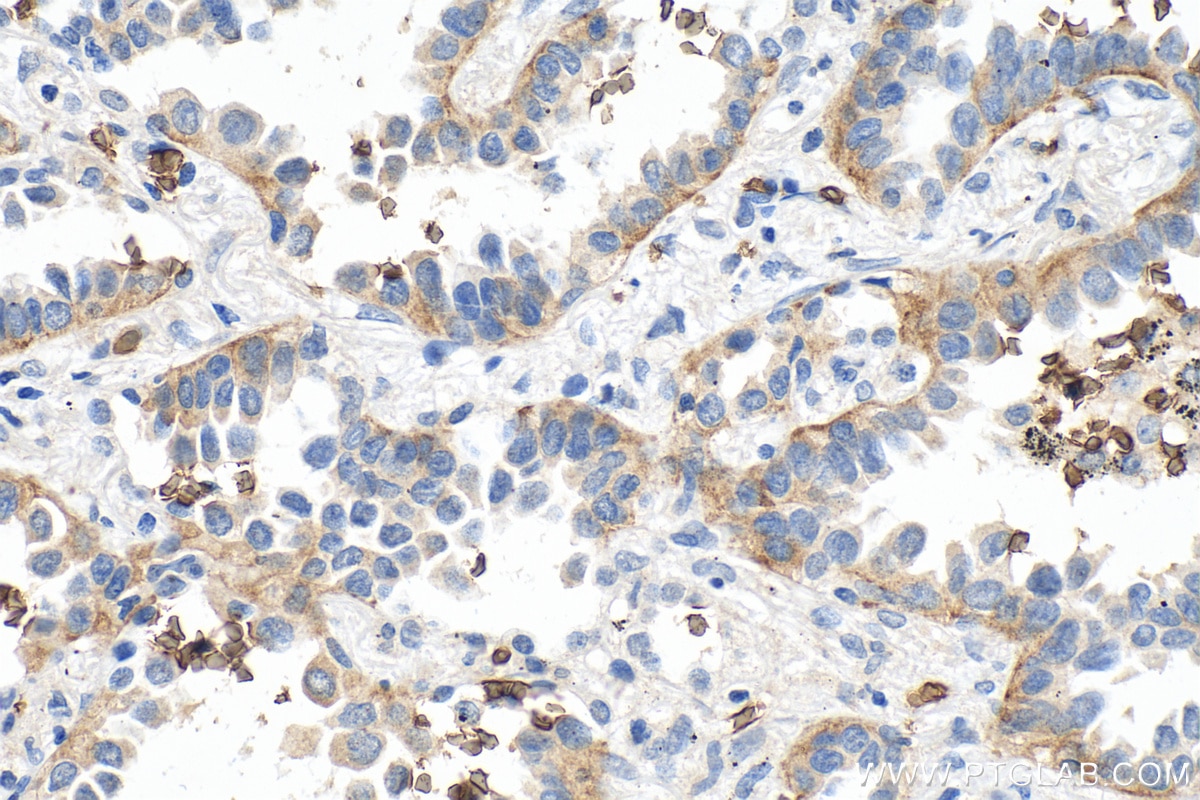 Immunohistochemistry (IHC) staining of human lung cancer tissue using GLUT1 Monoclonal antibody (66290-1-Ig)