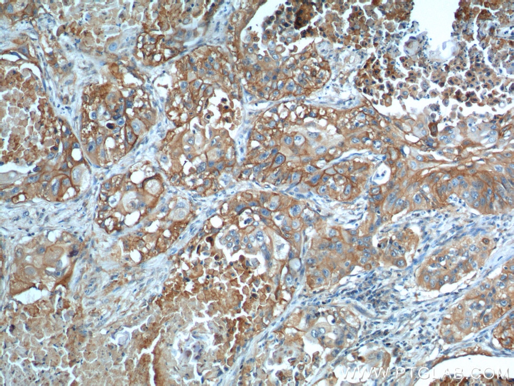 IHC staining of human lung cancer using 66290-1-Ig