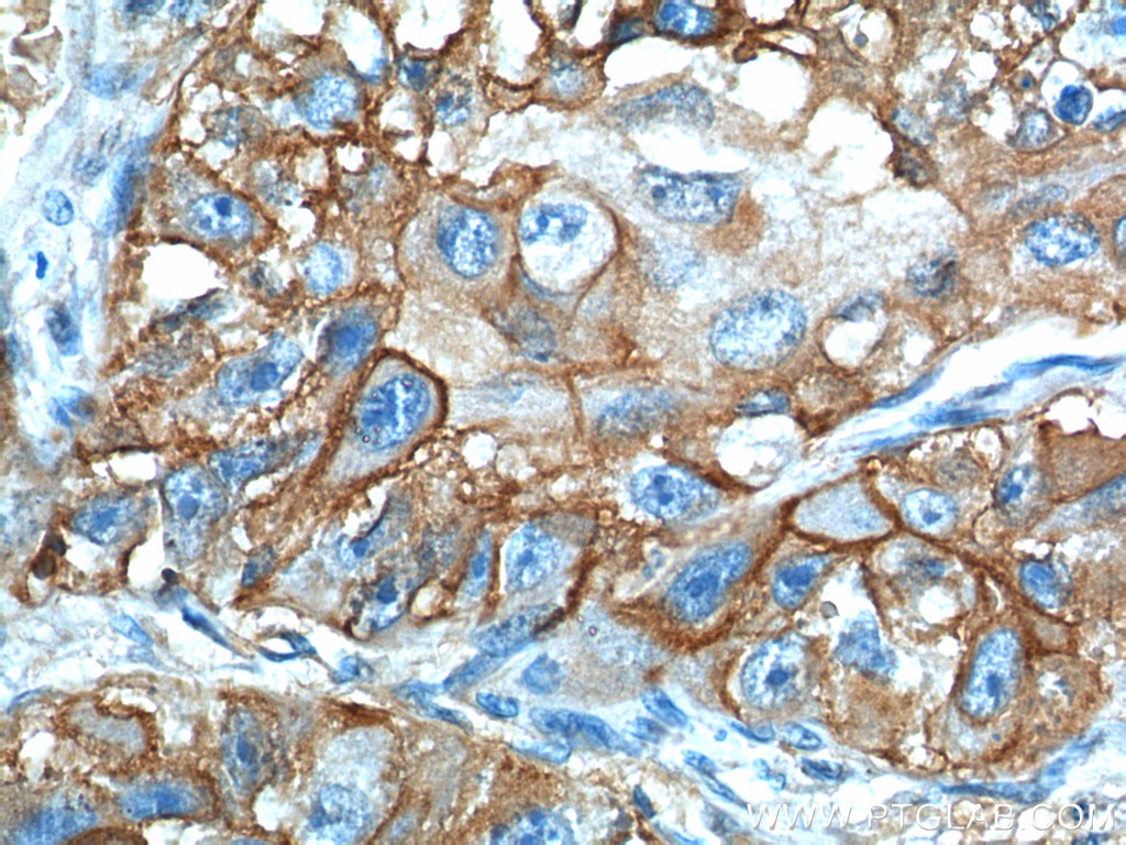 IHC staining of human lung cancer using 66290-1-Ig