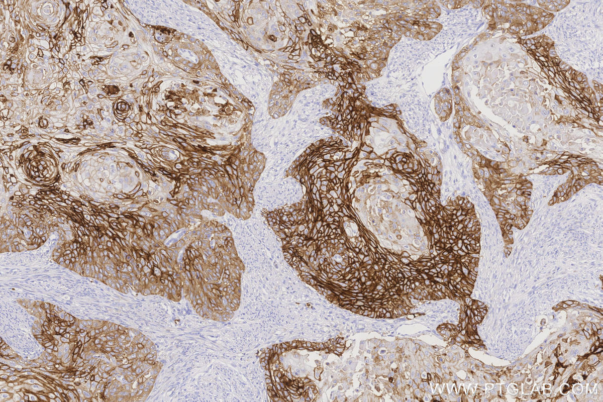 IHC staining of human cervical cancer using 66290-1-Ig Immunohistochemistry (IHC) staining of human cervical cancer tissue using GLUT1 Monoclonal antibody (66290-1-Ig)