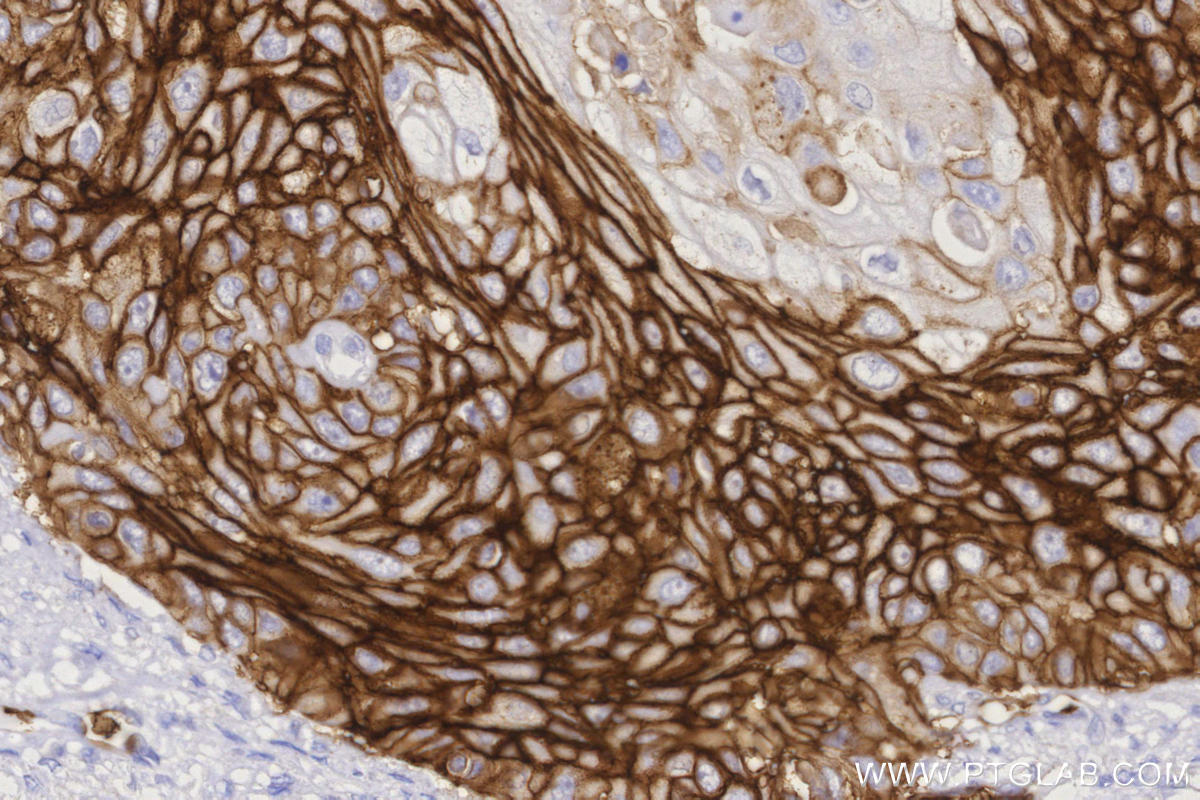 IHC staining of human cervical cancer using 66290-1-Ig Immunohistochemistry (IHC) staining of human cervical cancer tissue using GLUT1 Monoclonal antibody (66290-1-Ig)