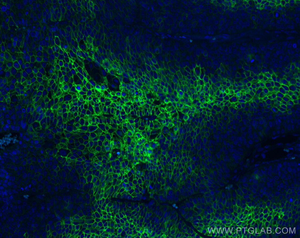 Immunofluorescence (IF) / fluorescent staining of human lung cancer tissue using CoraLite® Plus 488-conjugated GLUT1 Monoclonal ant (CL488-66290)