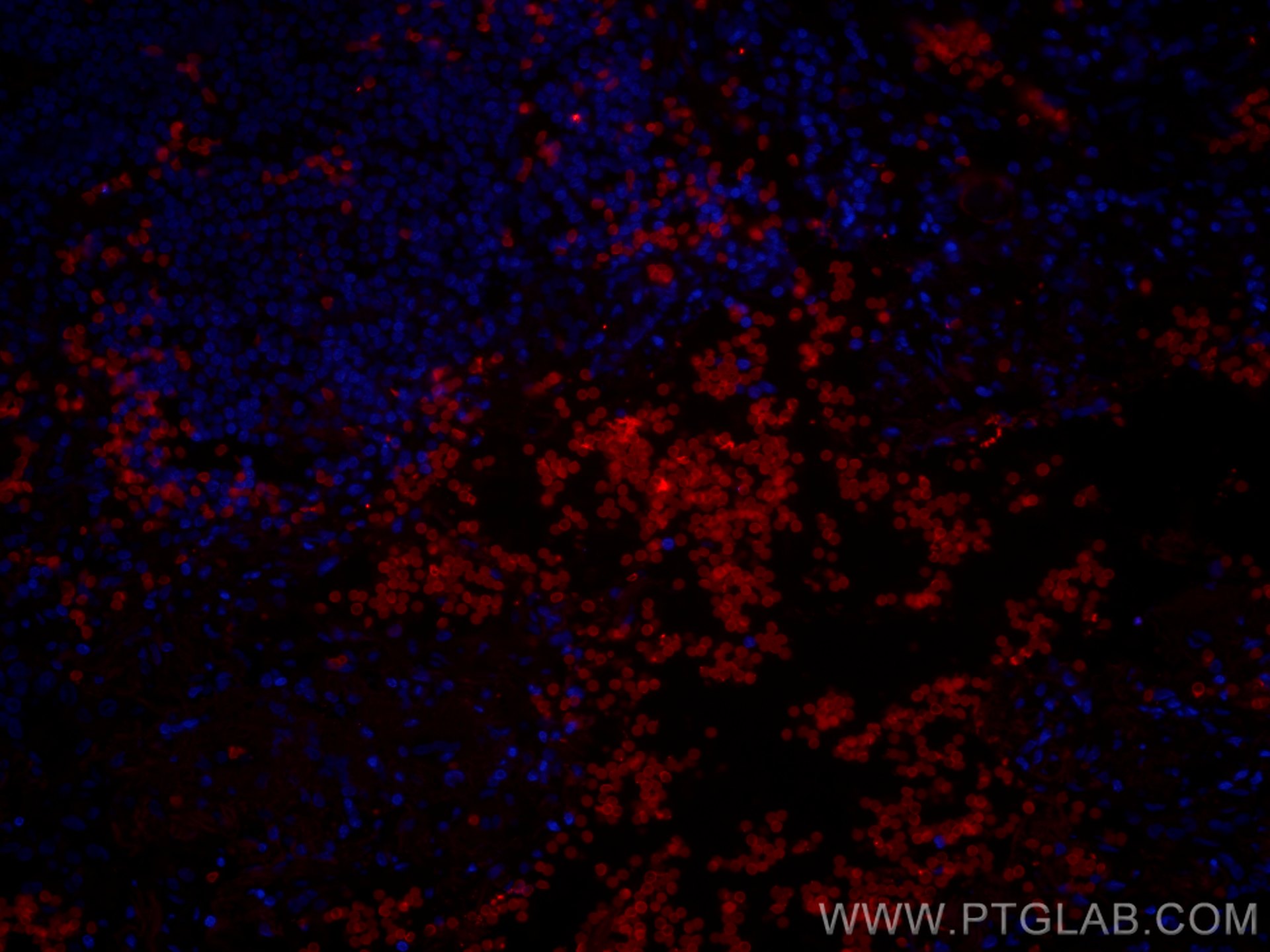 Immunofluorescence (IF) / fluorescent staining of human lung cancer tissue using CoraLite®594-conjugated GLUT1 Monoclonal antibody (CL594-66290)