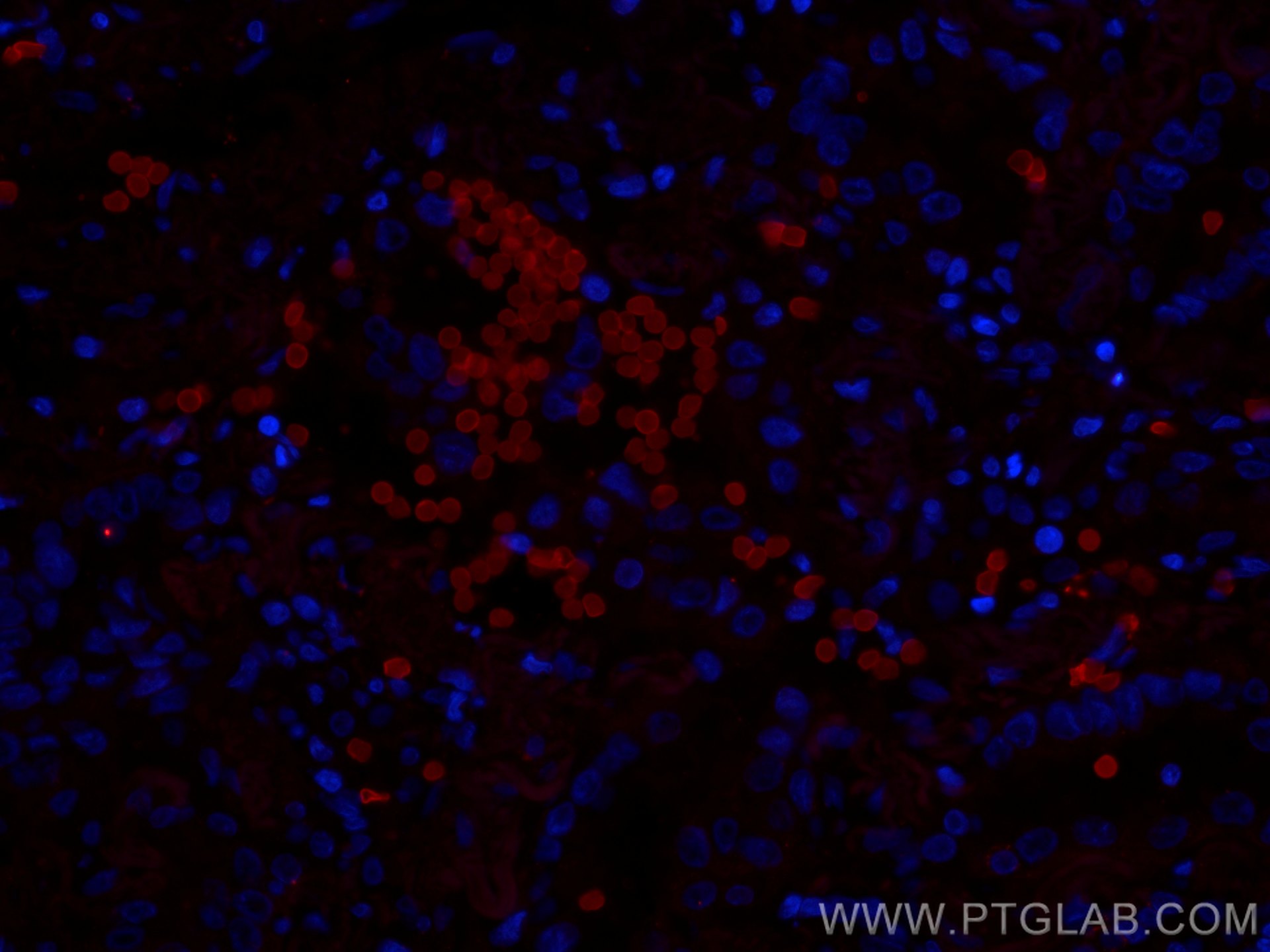 Immunofluorescence (IF) / fluorescent staining of human lung cancer tissue using CoraLite®594-conjugated GLUT1 Monoclonal antibody (CL594-66290)
