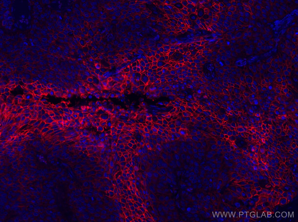 Immunofluorescence (IF) / fluorescent staining of human lung cancer tissue using CoraLite®594-conjugated GLUT1 Monoclonal antibody (CL594-66290)