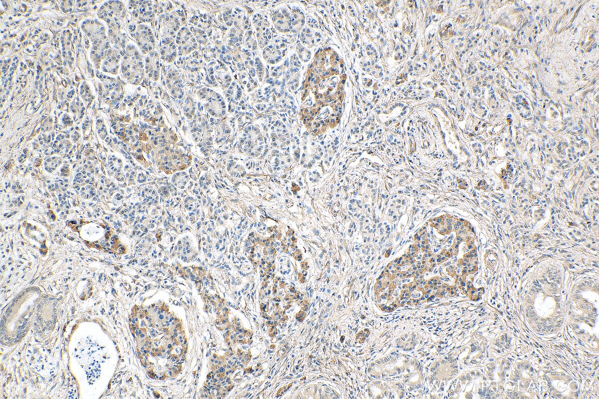 Immunohistochemistry (IHC) staining of human pancreas cancer tissue using GLUT2 Monoclonal antibody (66889-1-Ig)