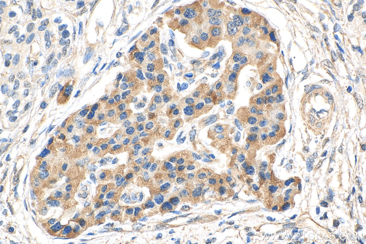 Immunohistochemistry (IHC) staining of human pancreas cancer tissue using GLUT2 Monoclonal antibody (66889-1-Ig)