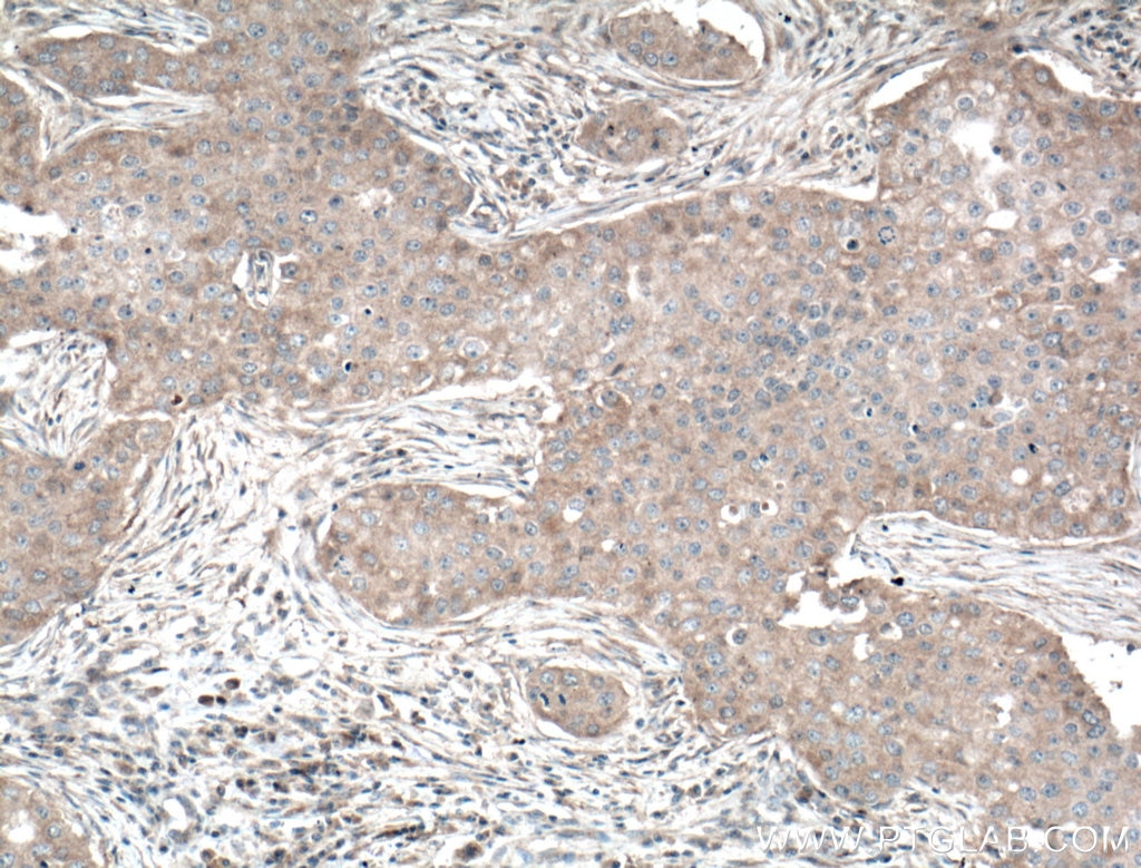 Immunohistochemistry (IHC) staining of human breast cancer tissue using GLUT5 Polyclonal antibody (27571-1-AP)