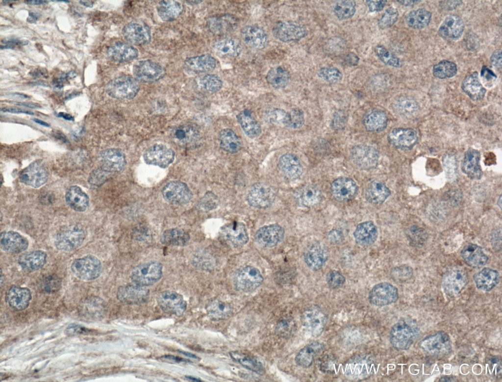 Immunohistochemistry (IHC) staining of human breast cancer tissue using GLUT5 Polyclonal antibody (27571-1-AP)