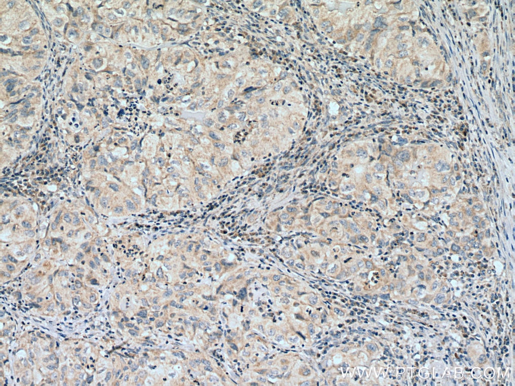 Immunohistochemistry (IHC) staining of human lung cancer tissue using GLUT5 Polyclonal antibody (27571-1-AP)
