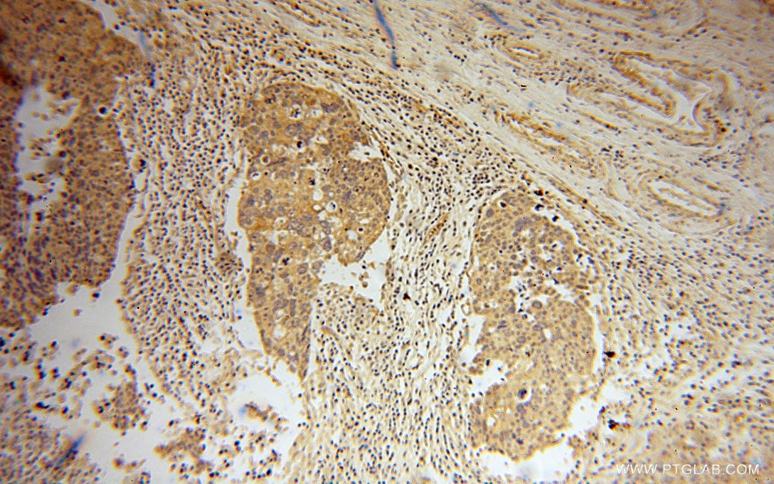 Immunohistochemistry (IHC) staining of human ovary tumor tissue using GLYATL1 Polyclonal antibody (15717-1-AP)