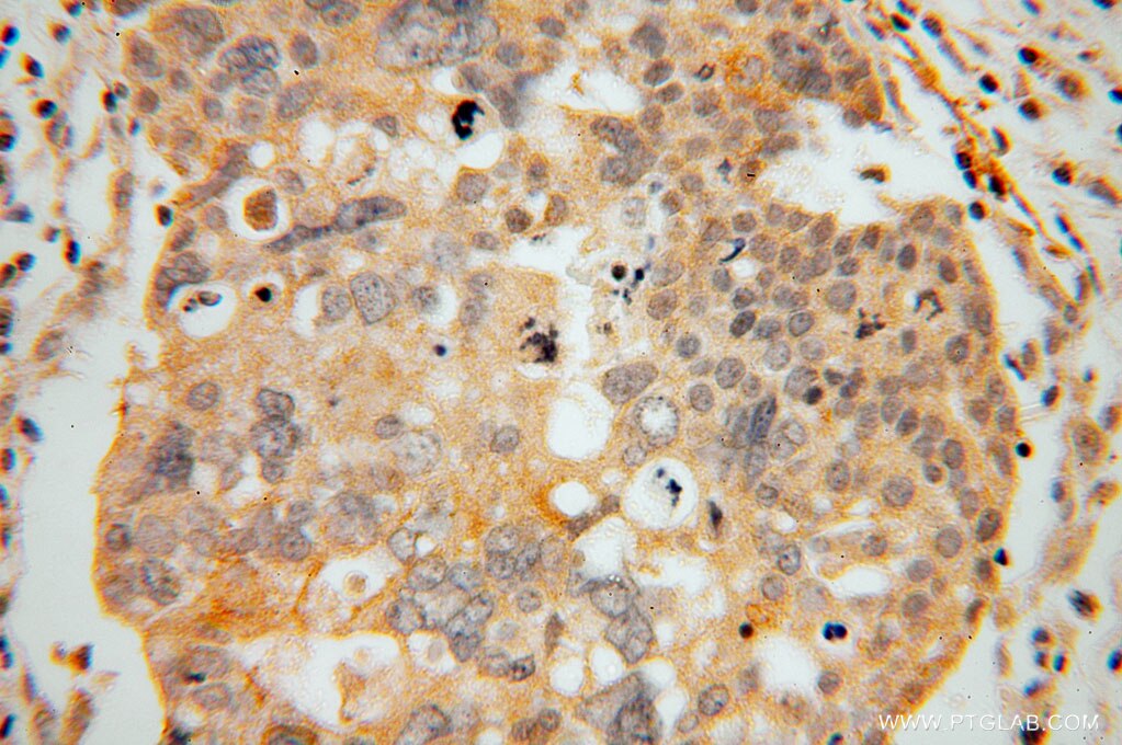 Immunohistochemistry (IHC) staining of human ovary tumor tissue using GLYATL1 Polyclonal antibody (15717-1-AP)