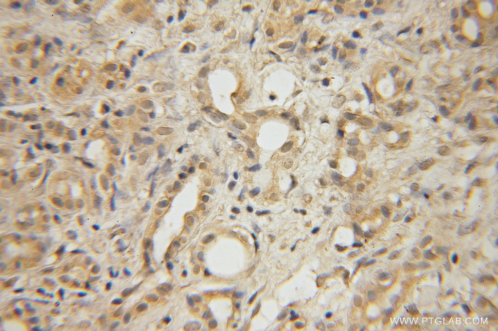 Immunohistochemistry (IHC) staining of human pancreas cancer tissue using GLYCTK Polyclonal antibody (12426-1-AP)