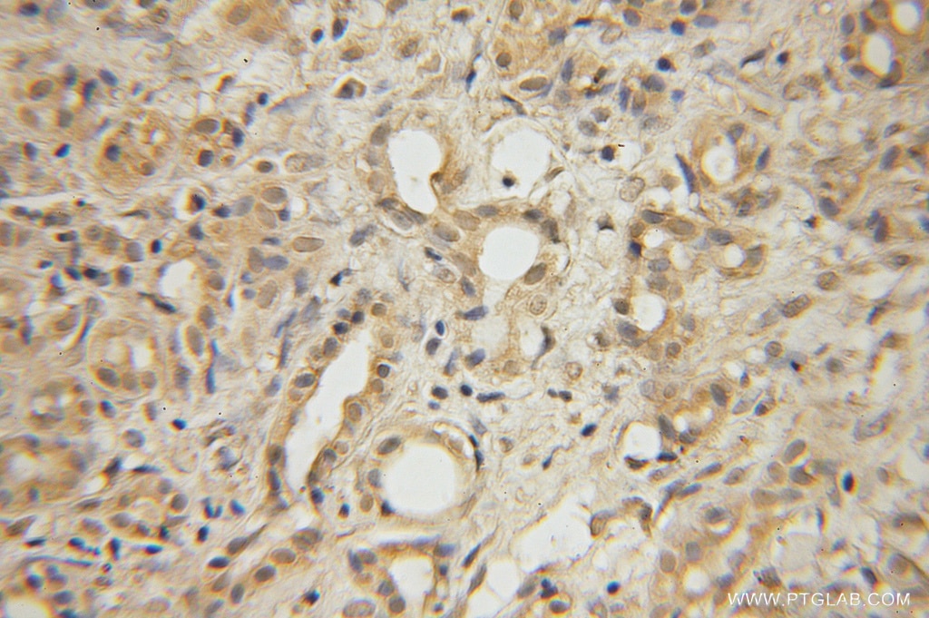 Immunohistochemistry (IHC) staining of human pancreas cancer tissue using GLYCTK Polyclonal antibody (12426-1-AP)