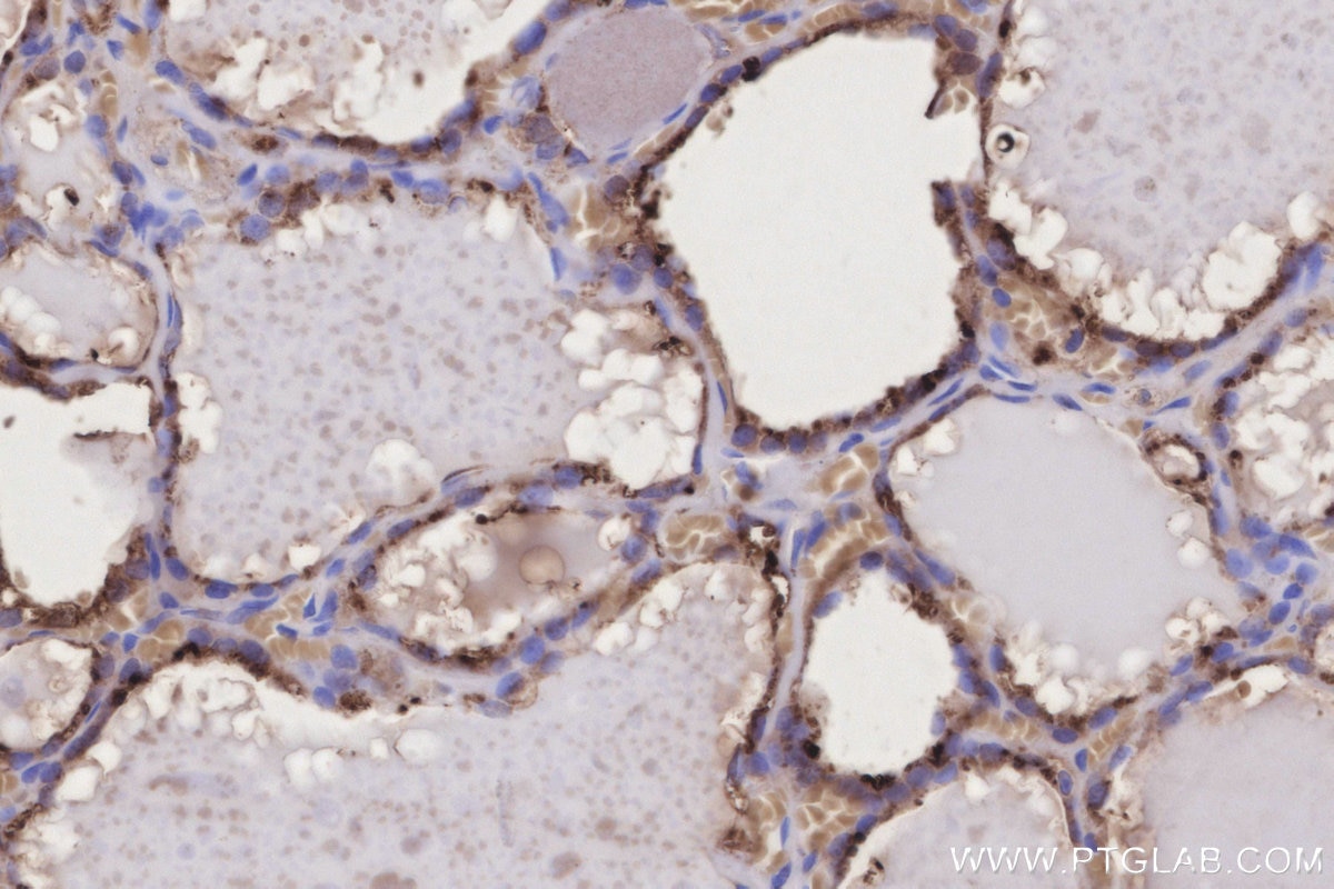 Immunohistochemistry (IHC) staining of human thyroid cancer tissue using GM2A Monoclonal antibody (66080-1-Ig)
