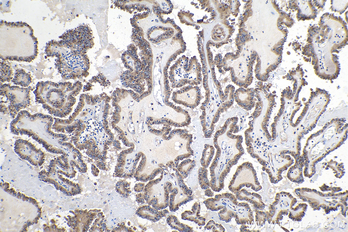 IHC staining of human thyroid cancer using 26456-1-AP