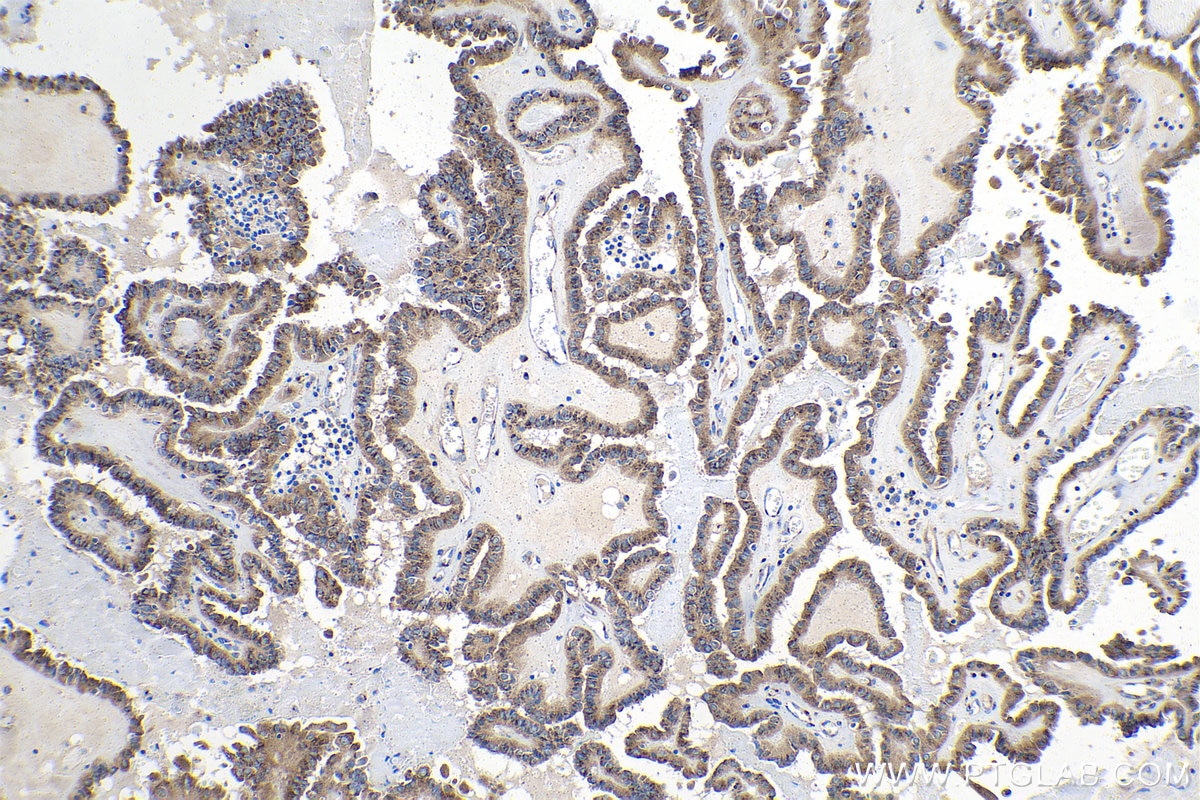 Immunohistochemistry (IHC) staining of human thyroid cancer tissue using GMAP-210 Polyclonal antibody (26456-1-AP)