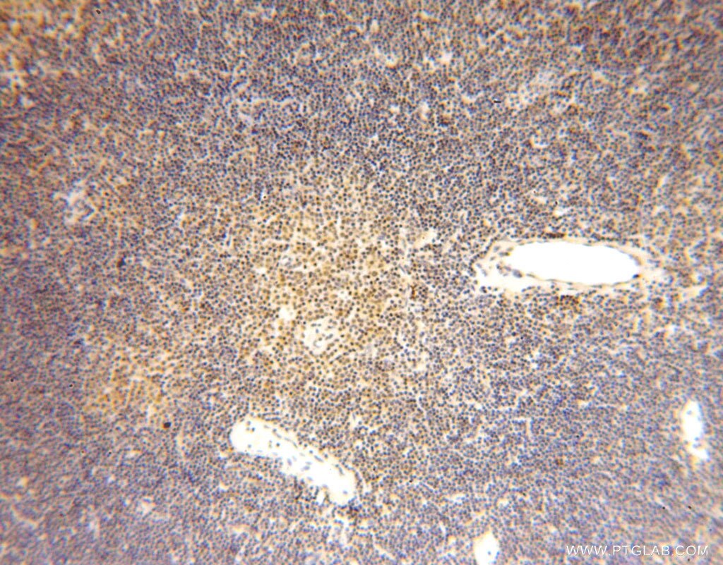 IHC staining of human lymphoma using 15442-1-AP