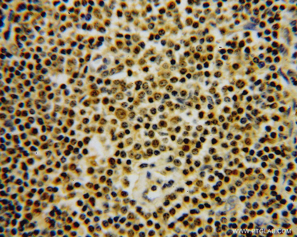 IHC staining of human lymphoma using 15442-1-AP