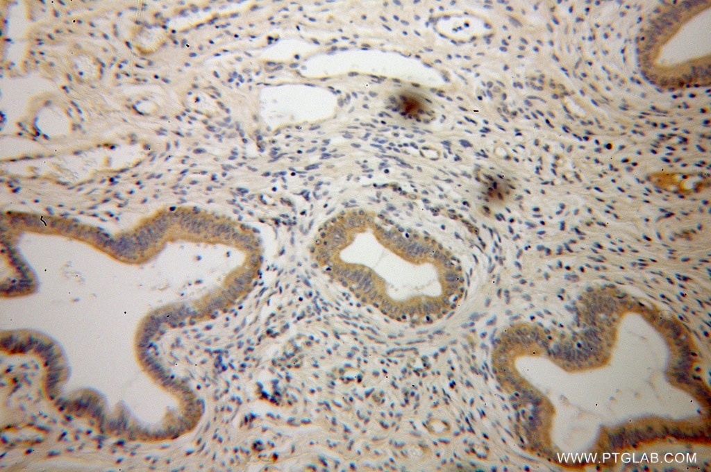 Immunohistochemistry (IHC) staining of human cervical cancer tissue using GMEB2 Polyclonal antibody (13314-1-AP)