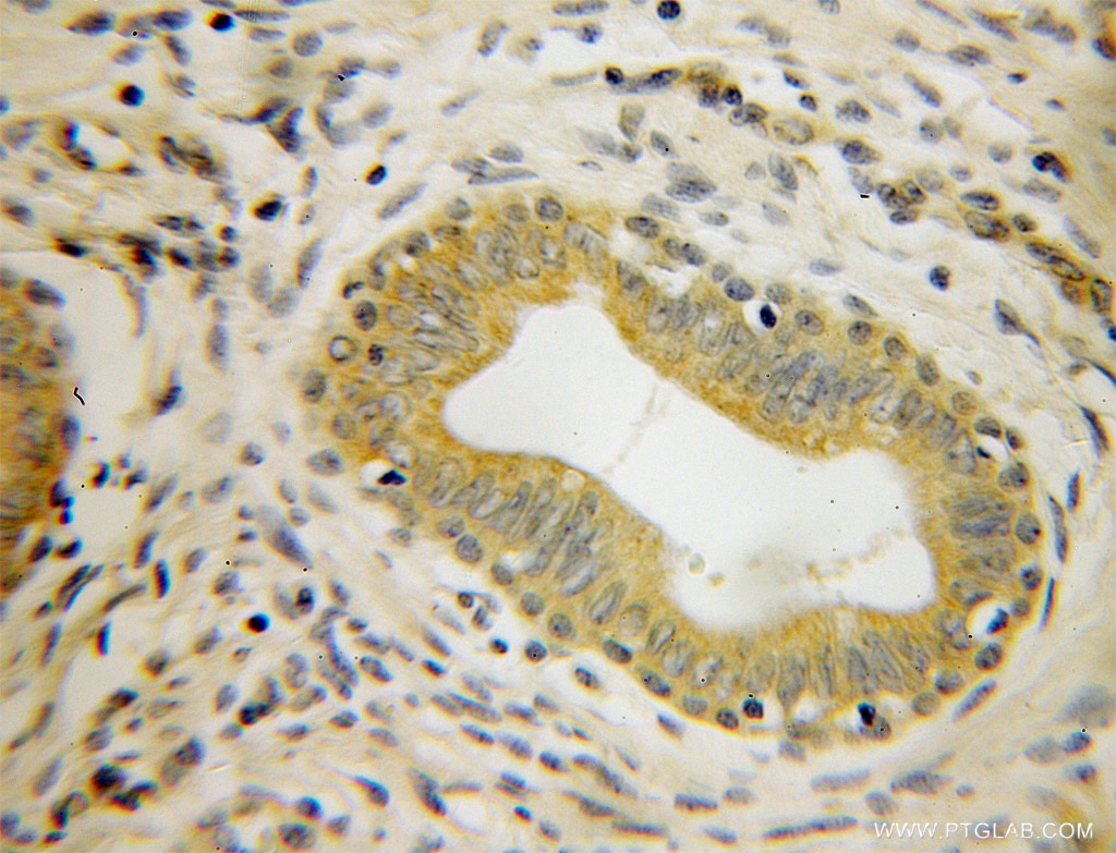 Immunohistochemistry (IHC) staining of human cervical cancer tissue using GMEB2 Polyclonal antibody (13314-1-AP)