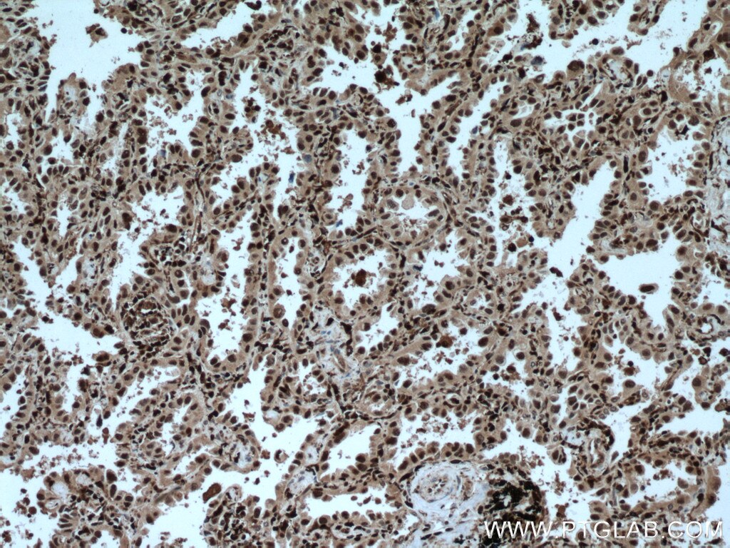 Immunohistochemistry (IHC) staining of human lung cancer tissue using GMFG Polyclonal antibody (13625-1-AP)