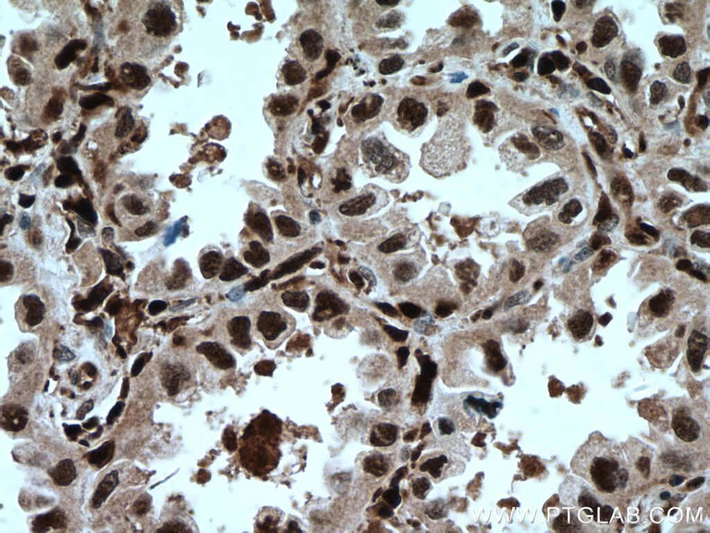 Immunohistochemistry (IHC) staining of human lung cancer tissue using GMFG Polyclonal antibody (13625-1-AP)