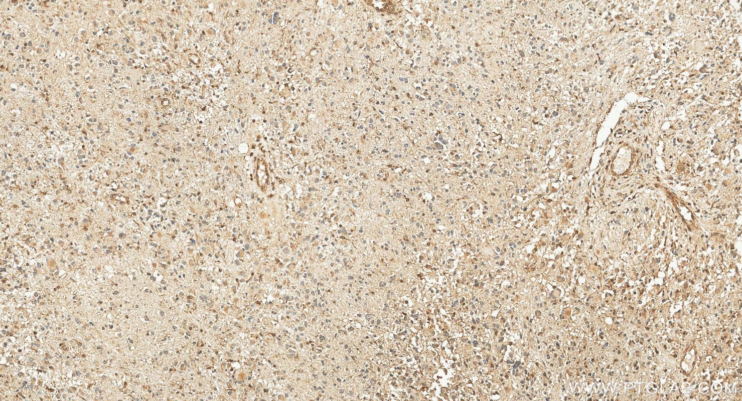 Immunohistochemistry (IHC) staining of human gliomas tissue using GMFG Polyclonal antibody (13625-1-AP)