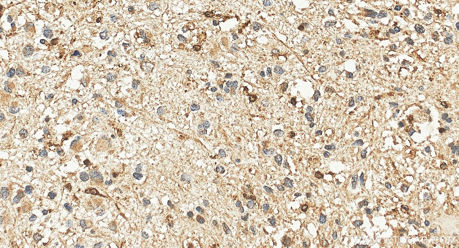 Immunohistochemistry (IHC) staining of human gliomas tissue using GMFG Polyclonal antibody (13625-1-AP)